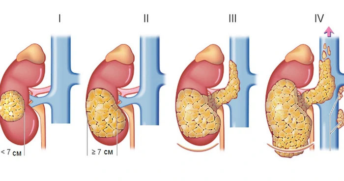 рак нирки стадії