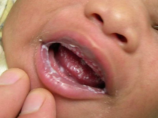 Грибковый стоматит (молочница) у ребенка