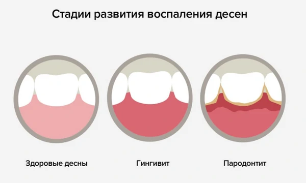 стадии развития воспаление десен
