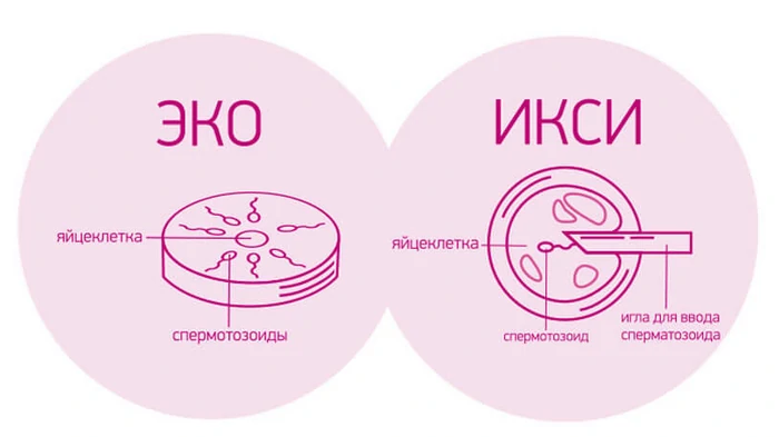 процедуры ЭКО с ИКСИ