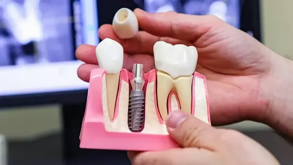 Кому подходит одномоментная имплантация зубов?
