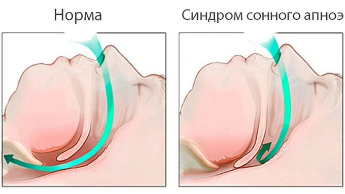храп (апноэ)