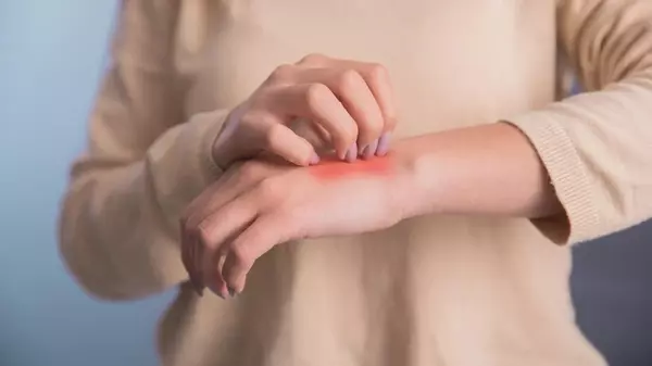 Атопический дерматит: его стадии и как облегчить симптомы