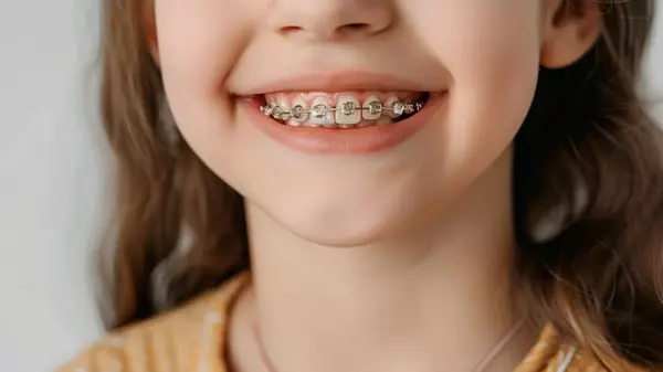 Исправление прикуса у детей: когда начинать и какой способ выбрать