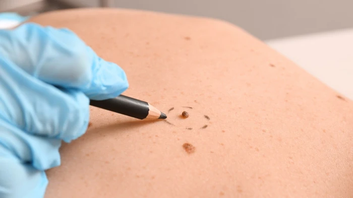 видалення родимок