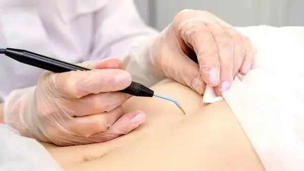 Видалення родимок в медичному центрі «Ангіолайт» — безпечно, професійно та естетично