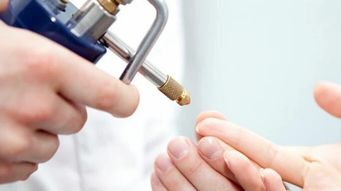 криодеструкция папиллом