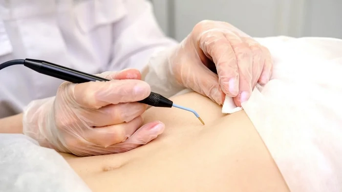 радиоволновой метод удаления папиллом