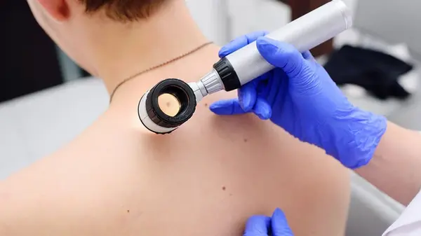 Современные методы удаления папиллом