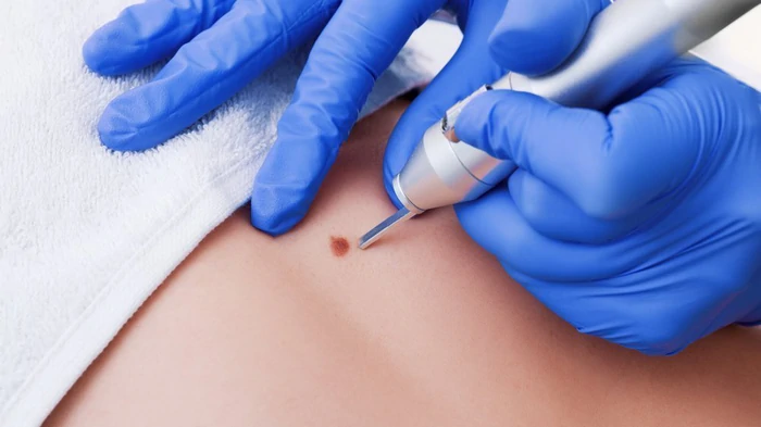 удаление бородавок