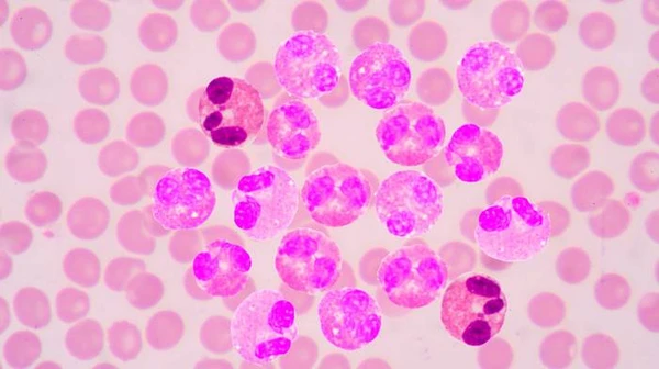 Хронический миелоидный лейкоз: что это за болезнь, ее симптомы и методы лечения