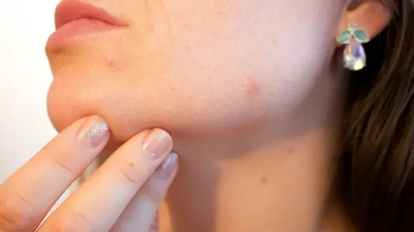 Прыщ на лице: действенный способ избавиться от воспаления за 3 минуты