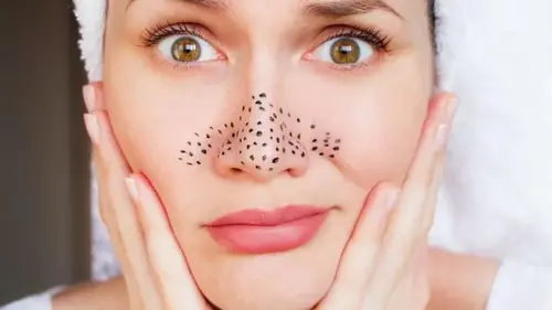 Перестаньте это делать: какие методы против черных точек сильно в...