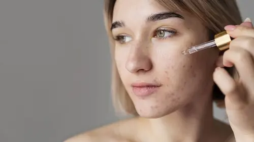 12 популярных мифов об акне, в которые до сих пор верят