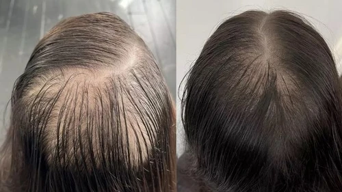 Трихопигментация волос: эффективно и безболезненно