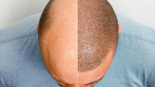 Трихопигментация волос: эффективно и безболезненно