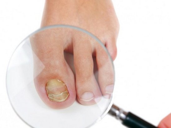 Грибок ногтей: эффективное лечение в домашних условиях