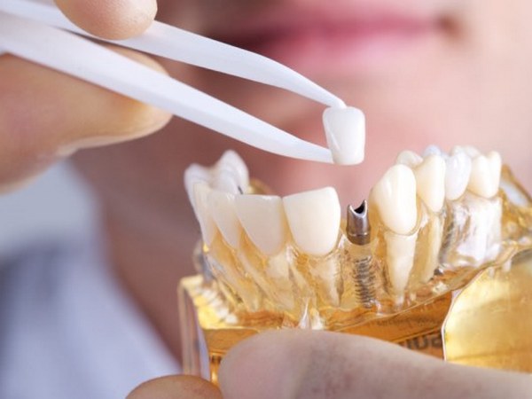 Какие преимущества и недостатки имплантации зубов?